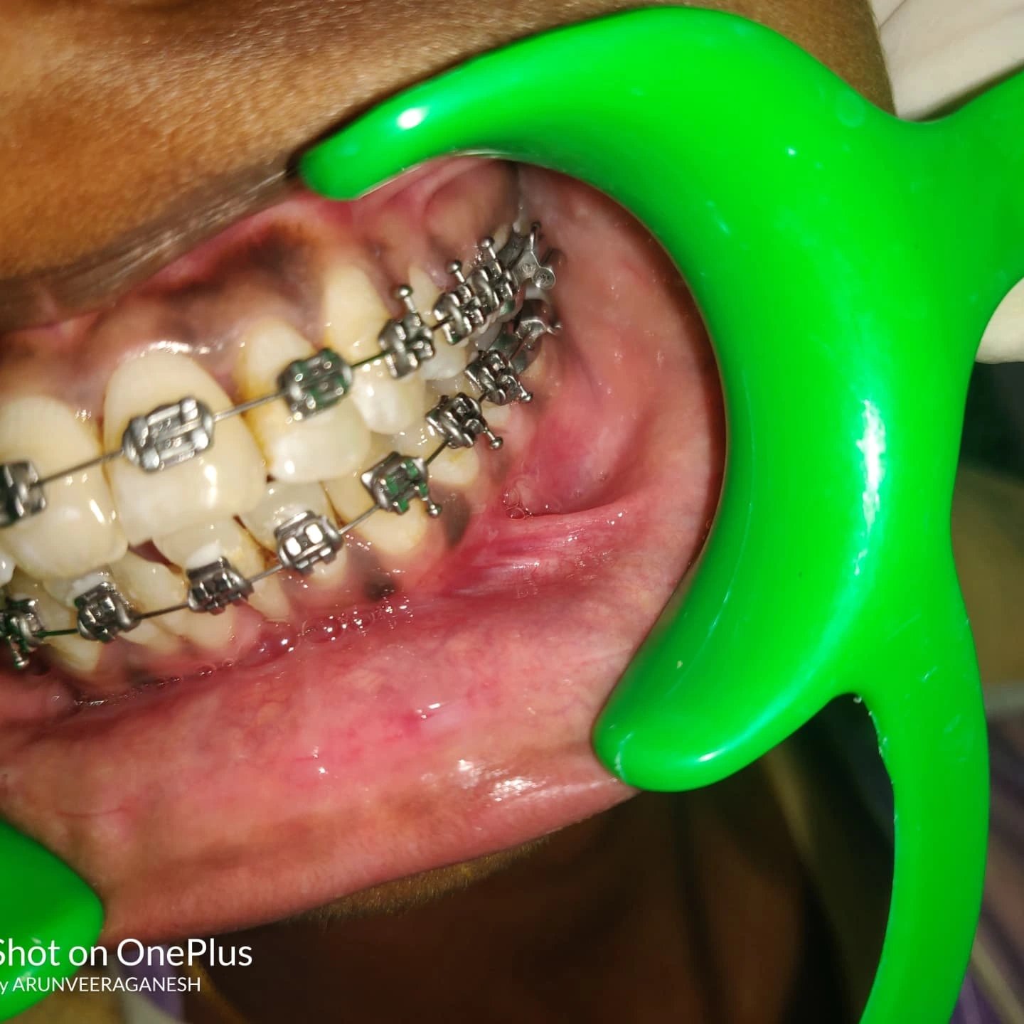 Actual braces case treated at Prema Dental Clinic, Ramanathapuram