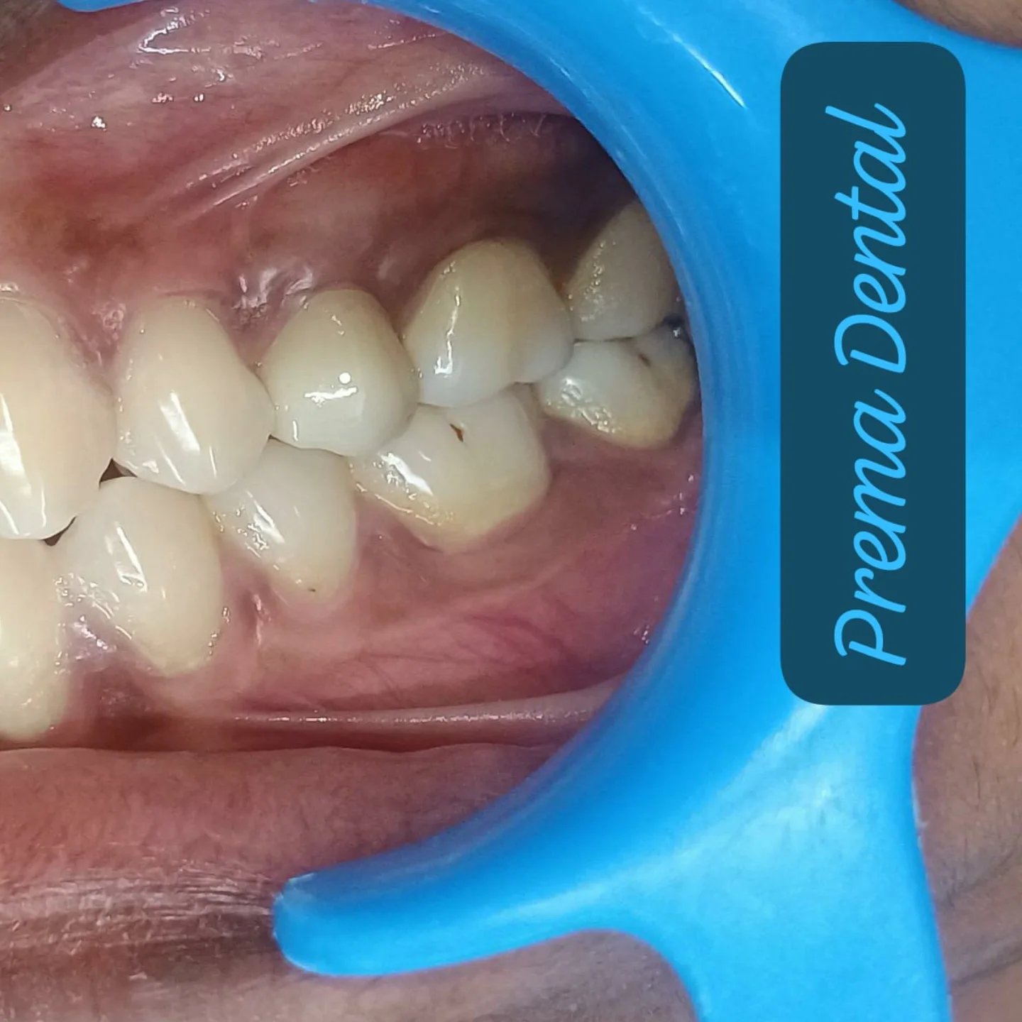 Healthy, confident smile - Prema Dental Clinic patient result